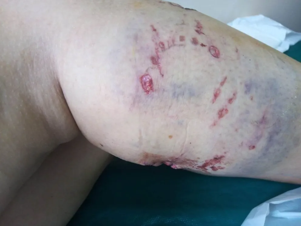 Otro salvaje ataque de perros casi se lleva la vida de una vecina
