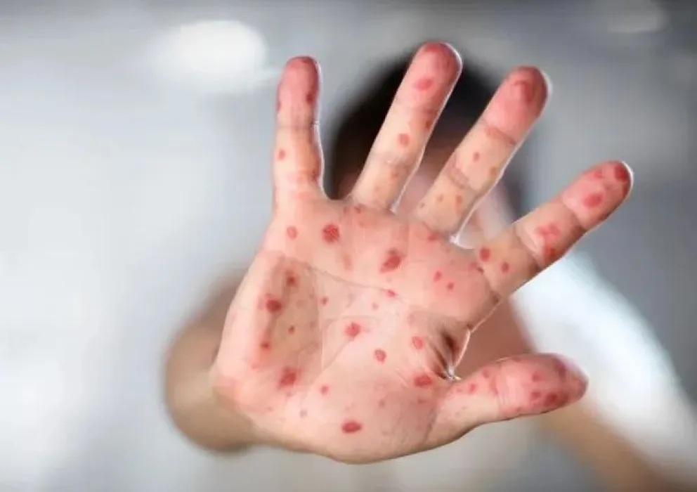 Se confirmó la primera muerte por la ex viruela del mono en Argentina