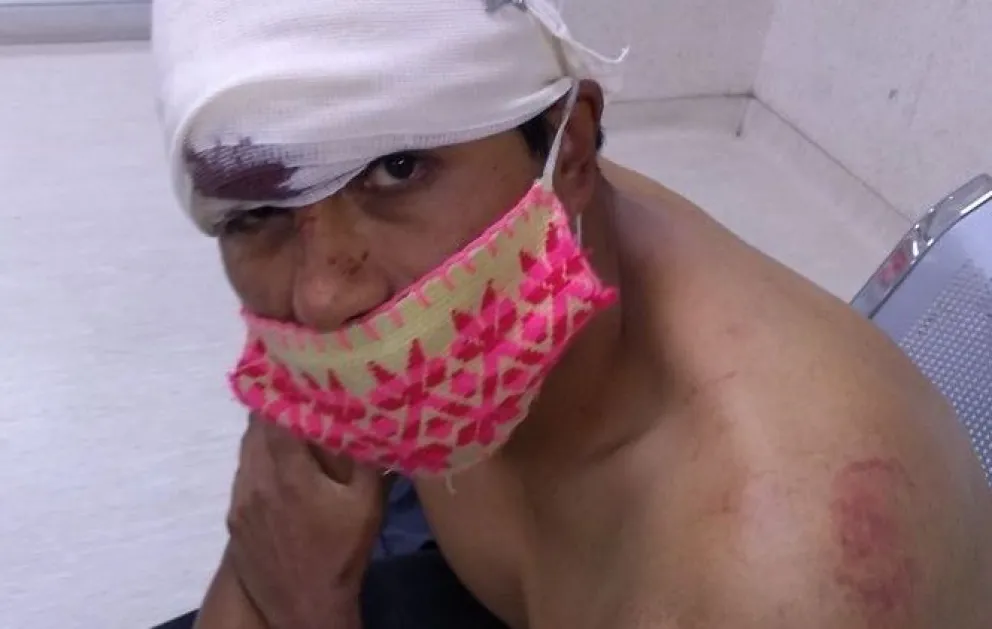 Le desfiguraron la cara para robarle su moto: hubo dos casos parecidos en menos de tres días