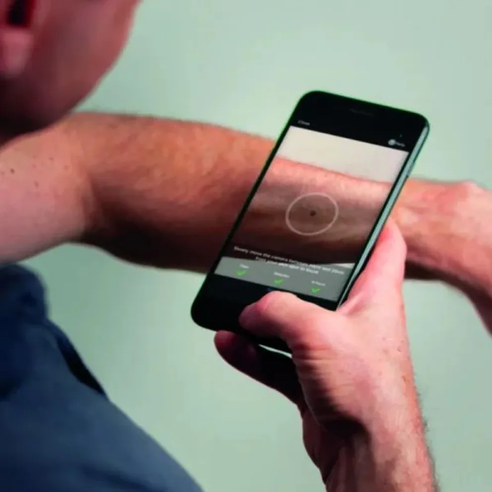 Tecnología y salud: conoce la app que detecta casos de cáncer de piel