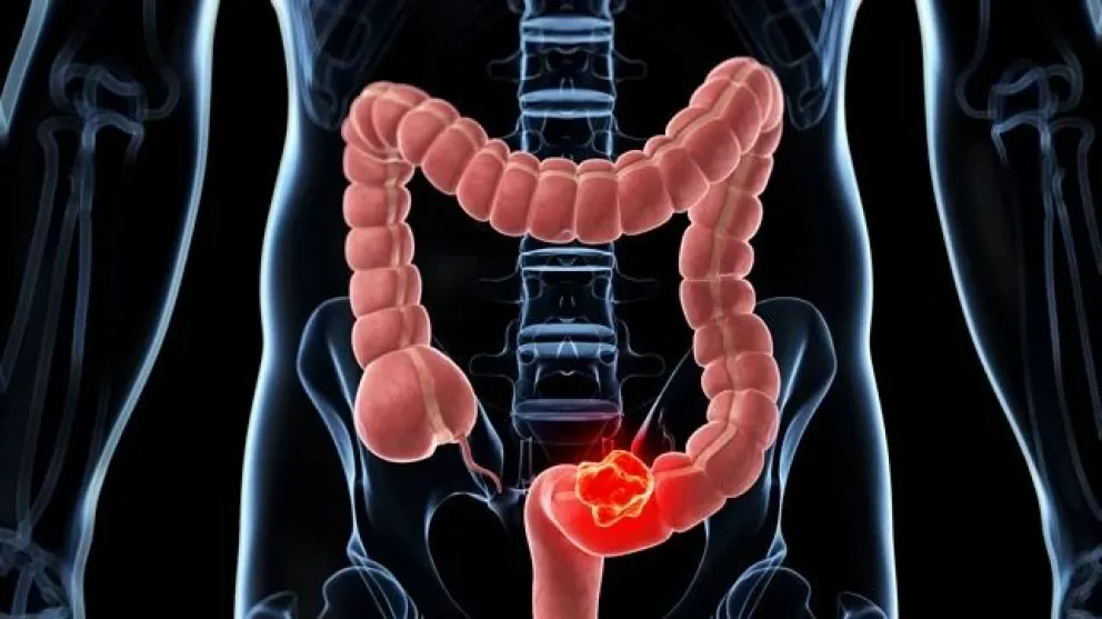 Día Mundial contra el Cáncer de Colon: preocupación por el aumento de casos en personas jóvenes