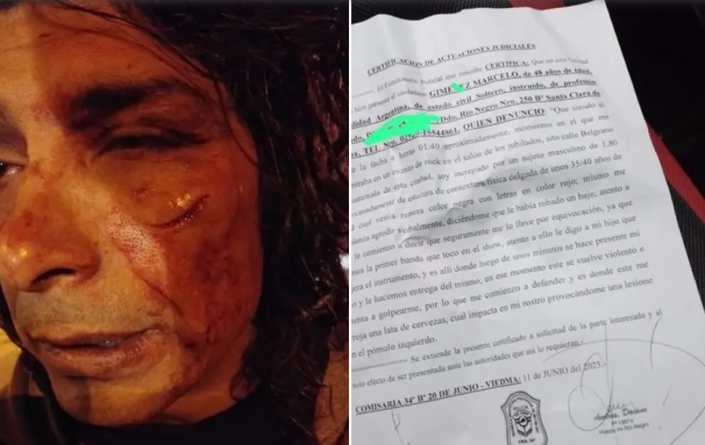 El músico herido con una lata de cerveza cargó contra la organización: “Casi pierdo un ojo por ayudarlas”
